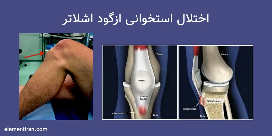 بیماری استخوانی ازگود اشلاتر