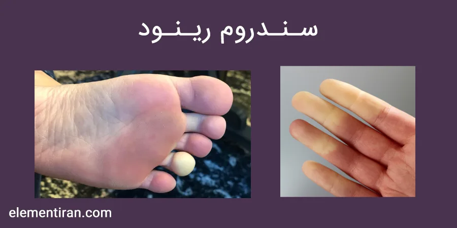 سندروم رینود