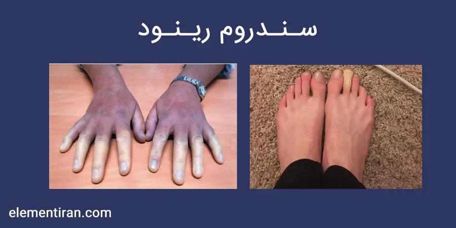 سندروم رینود