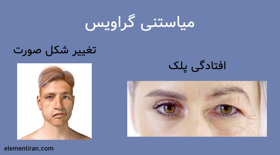میاستنی گراویس