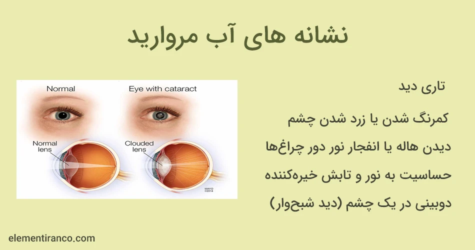 نشانه های آب مروارید